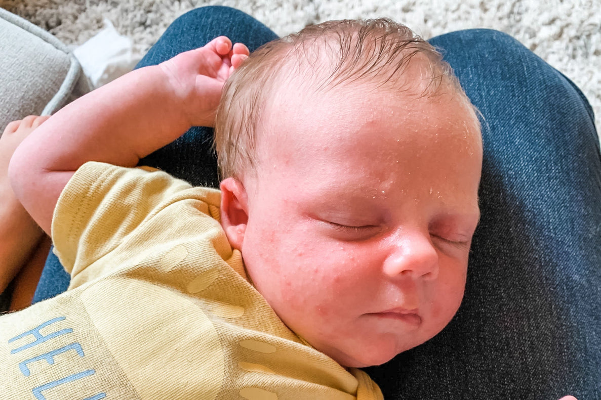 a closeup of a newborn with baby acne